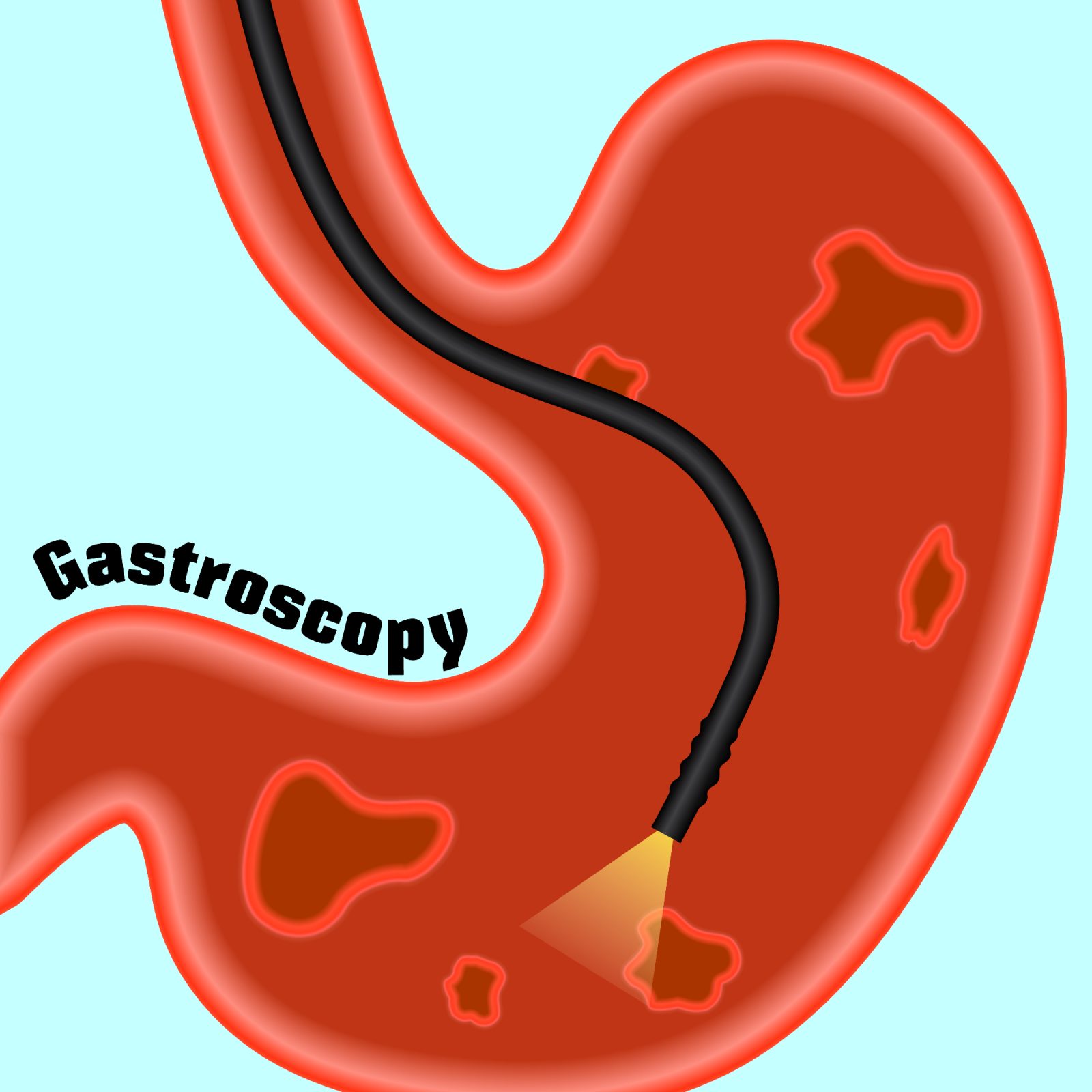 Gastroskopija samoplačniško je bila odločitev, ki sem jo sprejel zaradi sebe